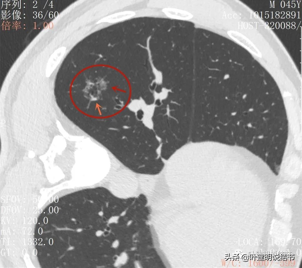 误诊肺纤维化,肺蜂窝状是癌吗