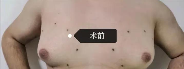 为什么男生的胸部很大,男生胸部大怎么办