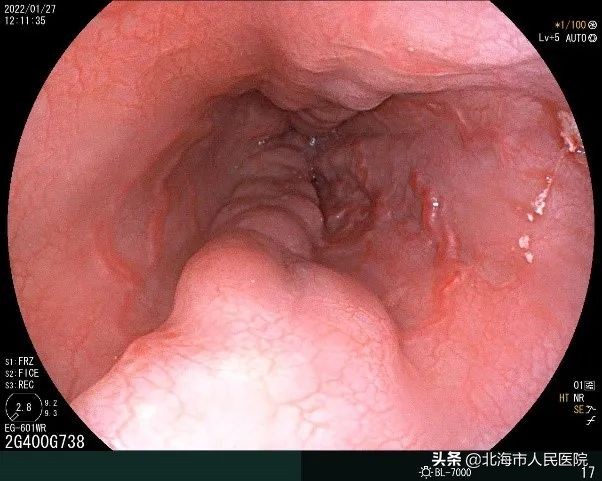 消化内科胃底静脉曲张治疗,消化内科静脉曲张手术费用