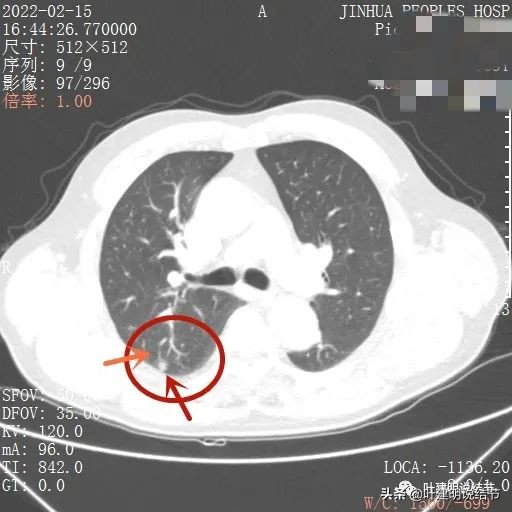 肺腺癌高危亚型什么意思,肺腺癌高危亚型