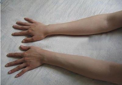 手萎缩无力是什么病,手腕无力手指笨拙虎口萎缩