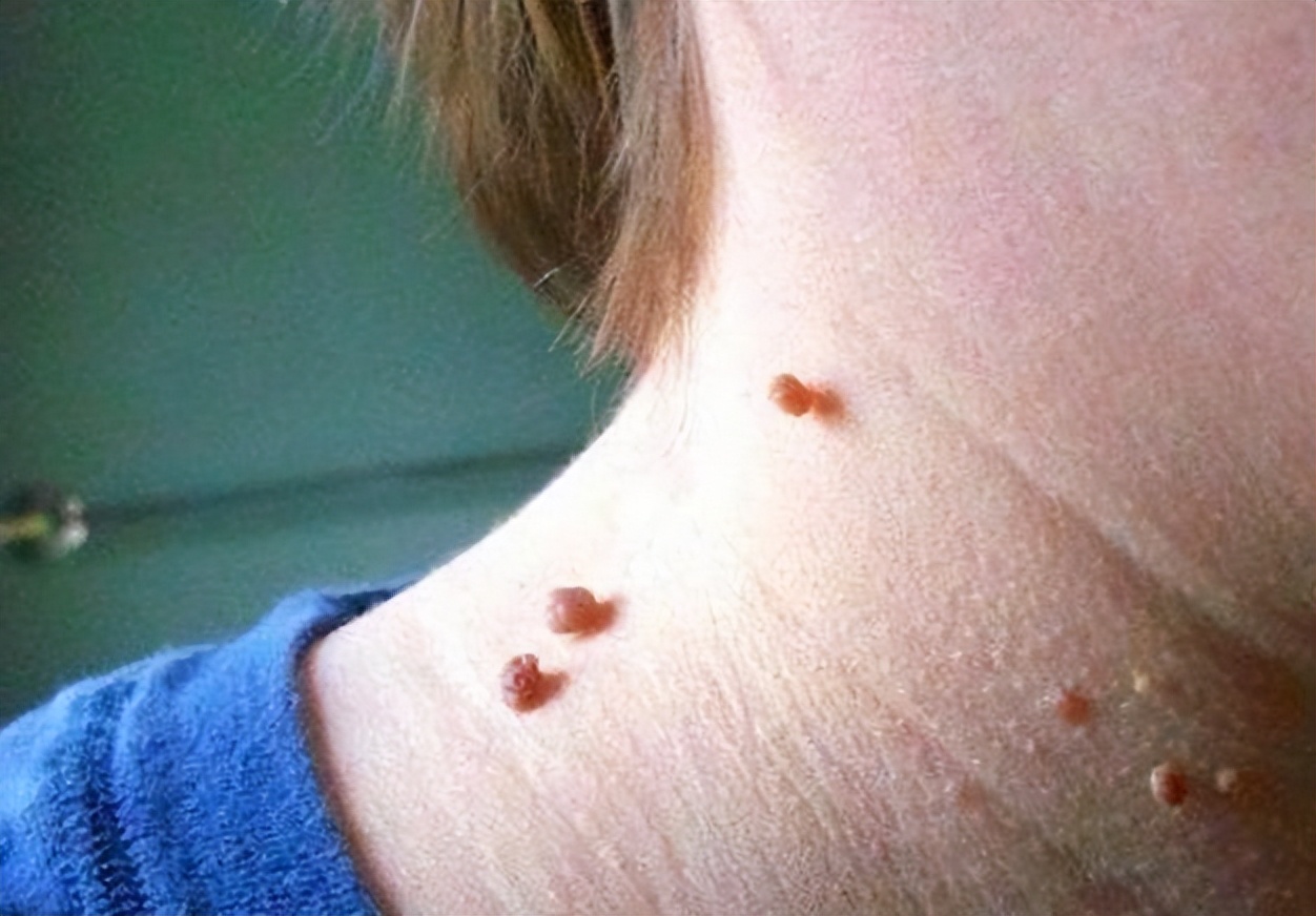 脖子上长了小肉粒可以自然消掉吗,脖子和腋下小肉粒是什么疣