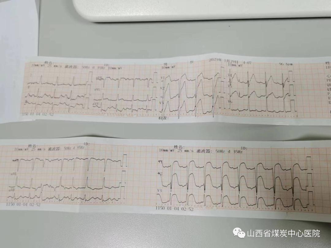 OCT辅助介入诊疗无植入！山西省煤炭中心医院成功抢救一名35岁急性心肌梗死患者