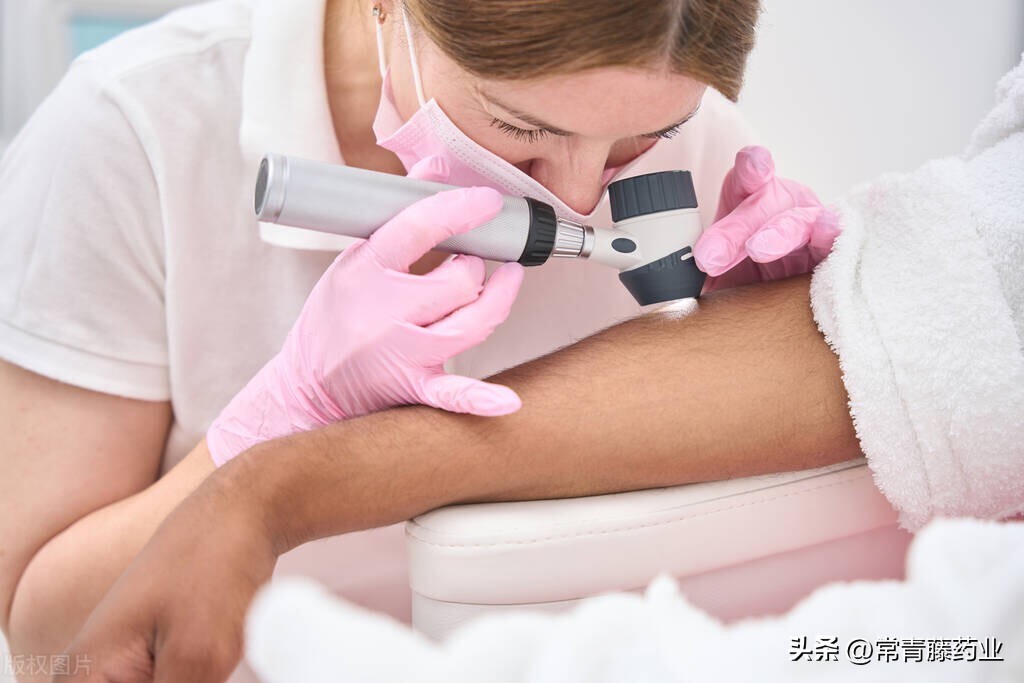 点痣容易癌变吗,点痣会得痤疮吗