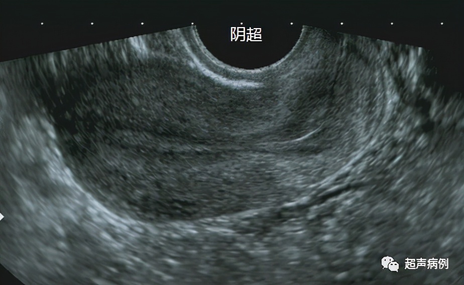 做阴道B超是一种什么样的体验？