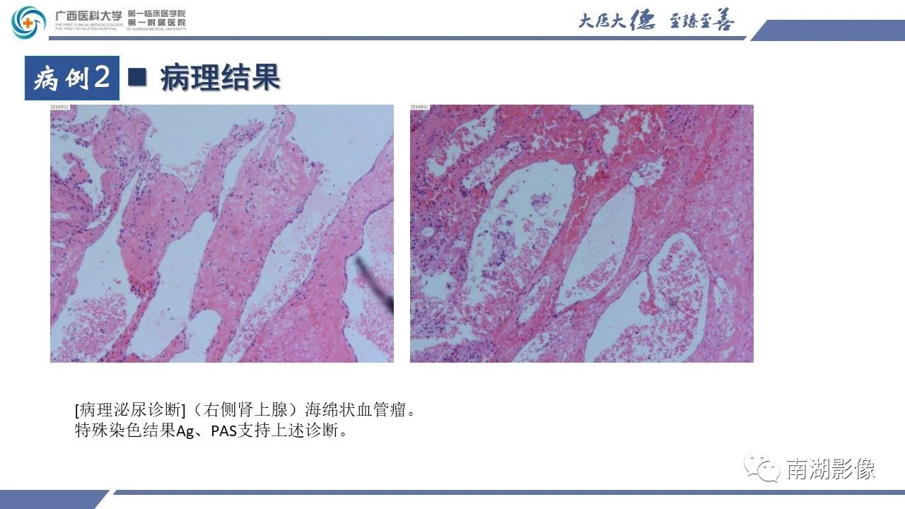 肾上腺海绵状血管瘤,肾上腺血管瘤是良性还是恶性