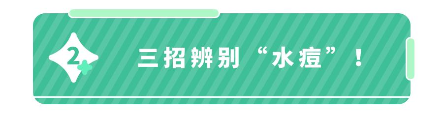 水痘疫苗哪个季节打合适,水痘高发的秘诀