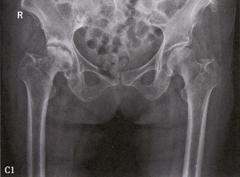 全国十大股骨头坏死诊疗中心,股骨头坏死诊疗方法有哪些