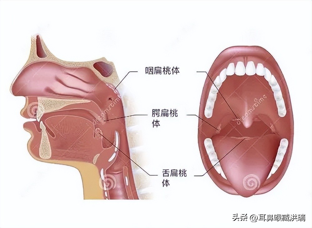 小孩腺样体和扁桃体肥大怎么缓解,小孩扁桃体肥大和腺样体肥大区别