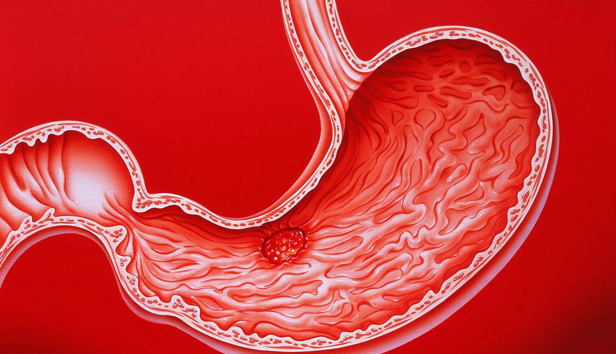 胃镜检查能查什么你真的了解吗,胃镜检查治疗前后注意事项是什么