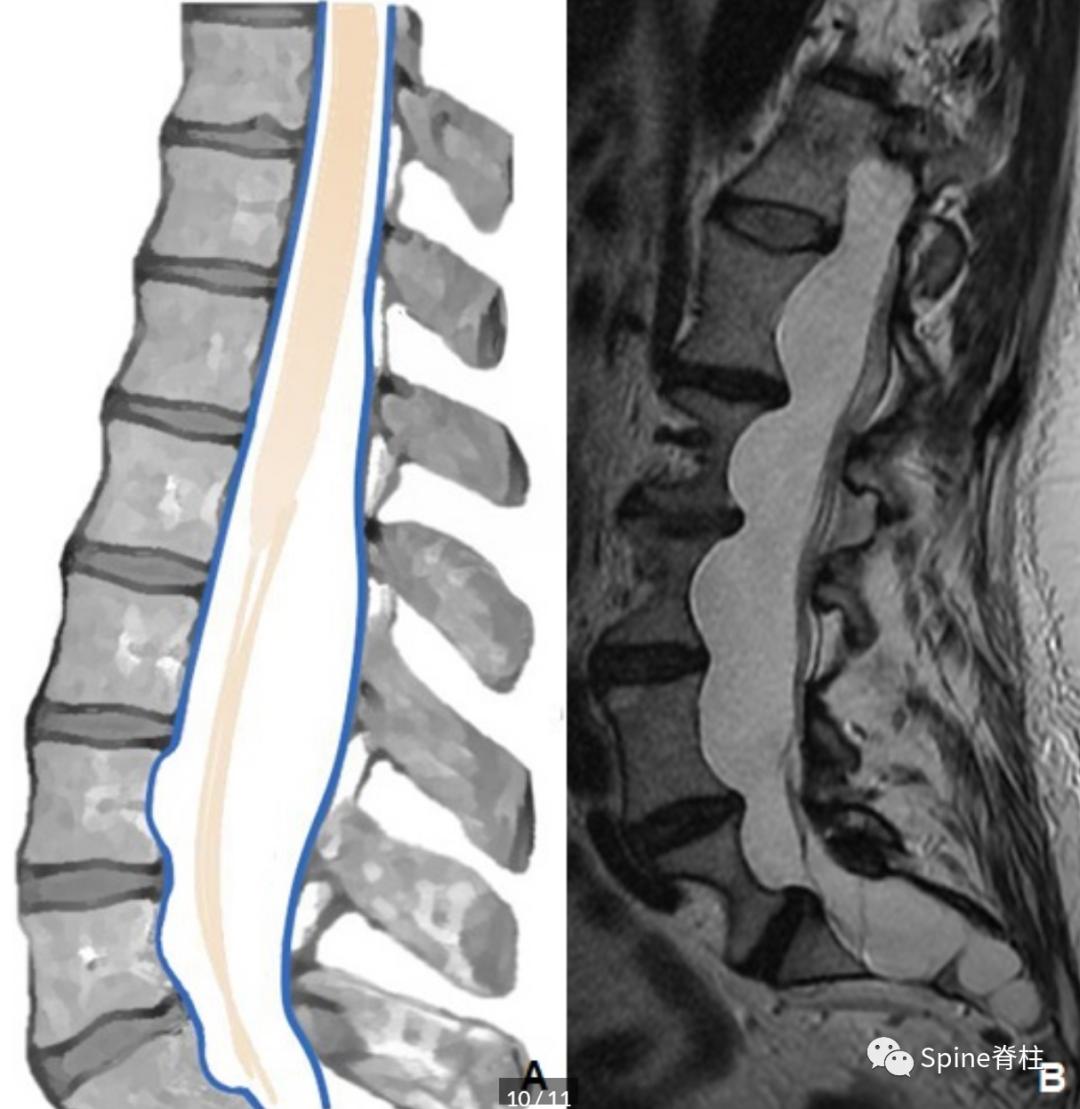 腰椎椎管有囊性结构,水平椎管内囊性占位