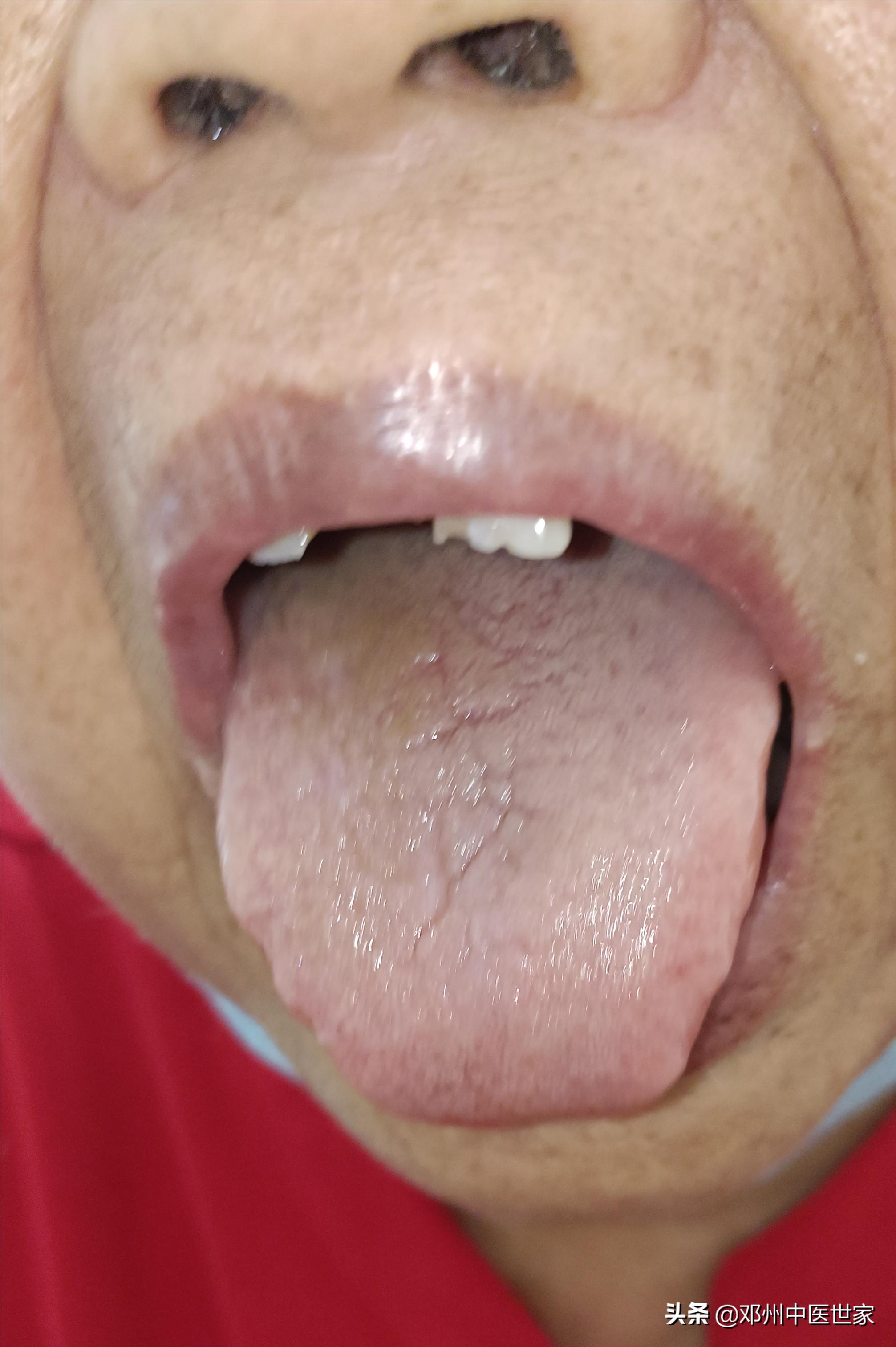 头晕中医病历模板,头晕病历模板