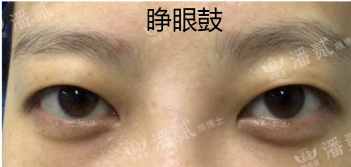 凸眼球显得眼睛大,凸眼眼窝凹陷