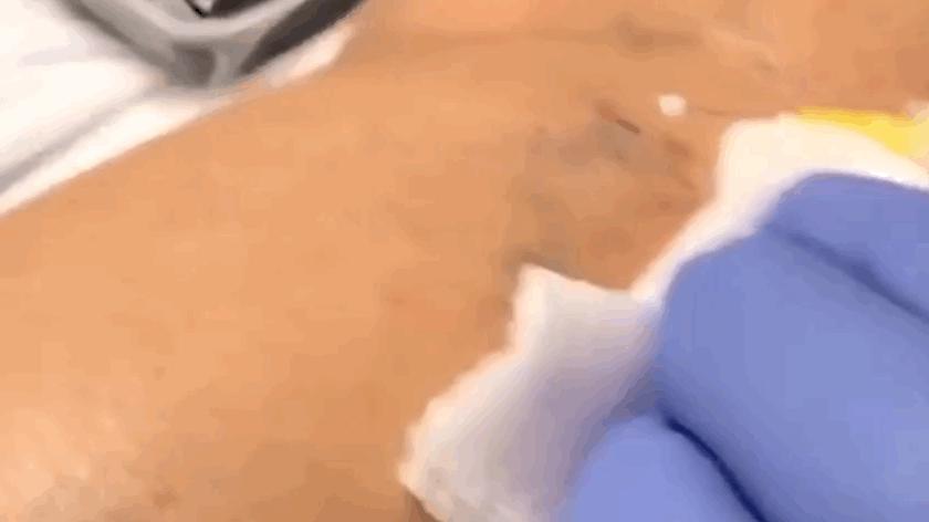 腿上出现蜘蛛网状血管怎么治疗,腿上蜘蛛状毛细血管是什么病