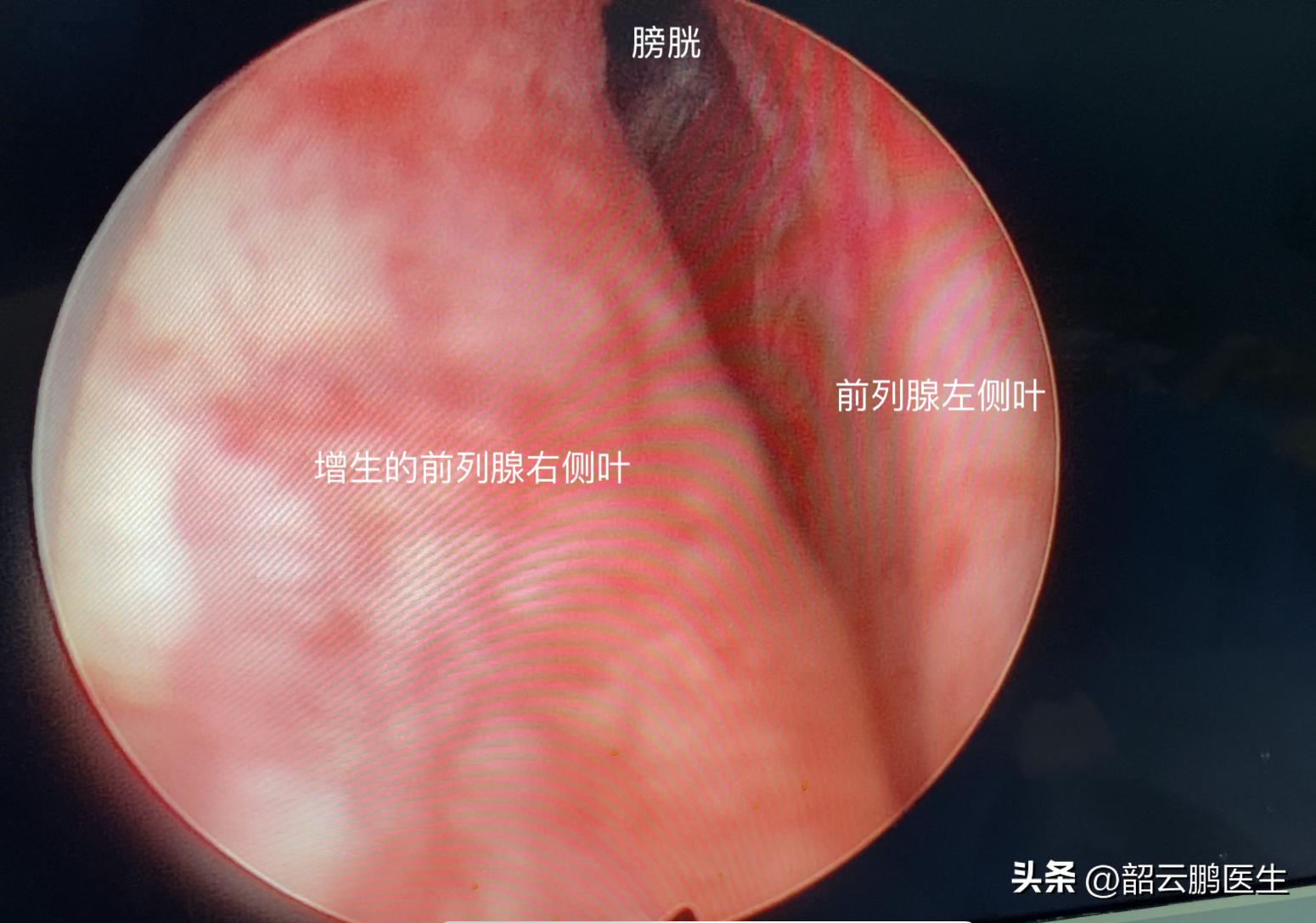 前列腺水蒸气消融术的缺点是什么,前列腺增生热疗消融手术靠谱吗