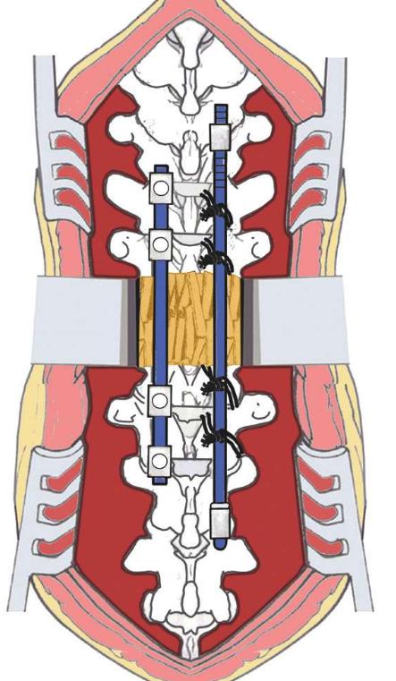 骨科基础：脊柱后侧凸截骨术