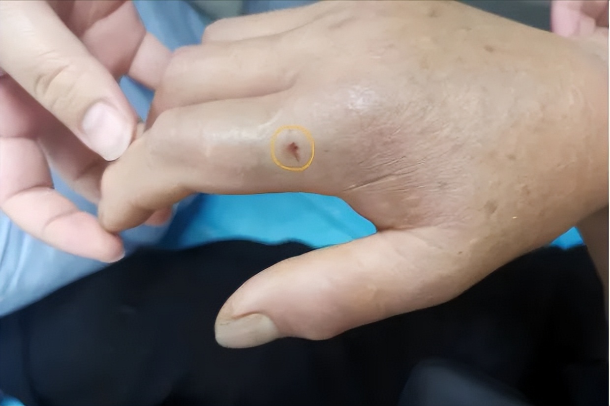 野外毒蛇咬伤急救方法,在农村路上碰到蛇怎么办