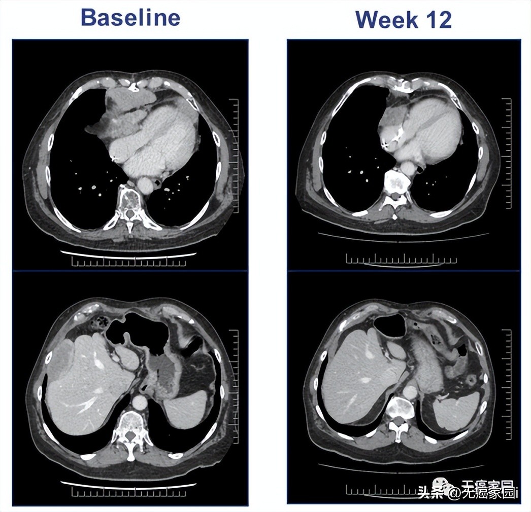 tcr-t疗法可以治疗哪些肿瘤,tcr-t细胞疗法成功率