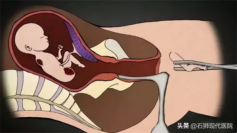 药流人流哪个好一点,人流药流怎么选