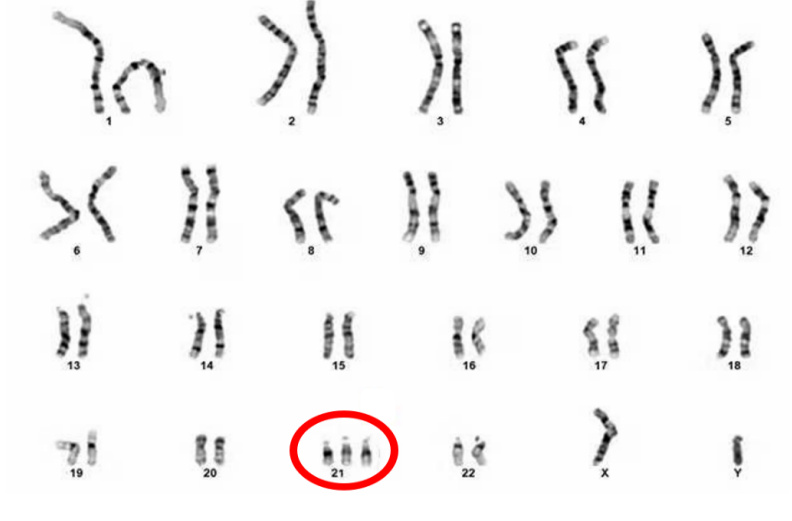 世界唐氏综合症怎么导致的,关于唐氏综合征的这些知识
