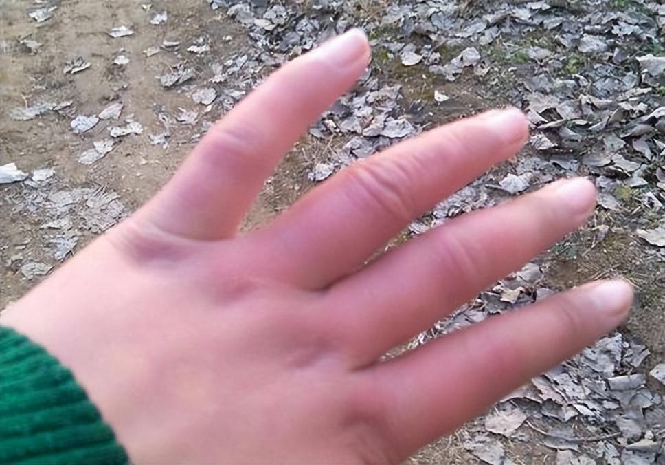 老人长老年斑很痒怎么办,白醋和红霉素软膏能去除老年斑吗