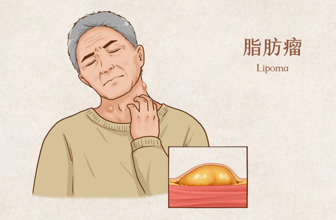 长出这种肉疙瘩，别大意！