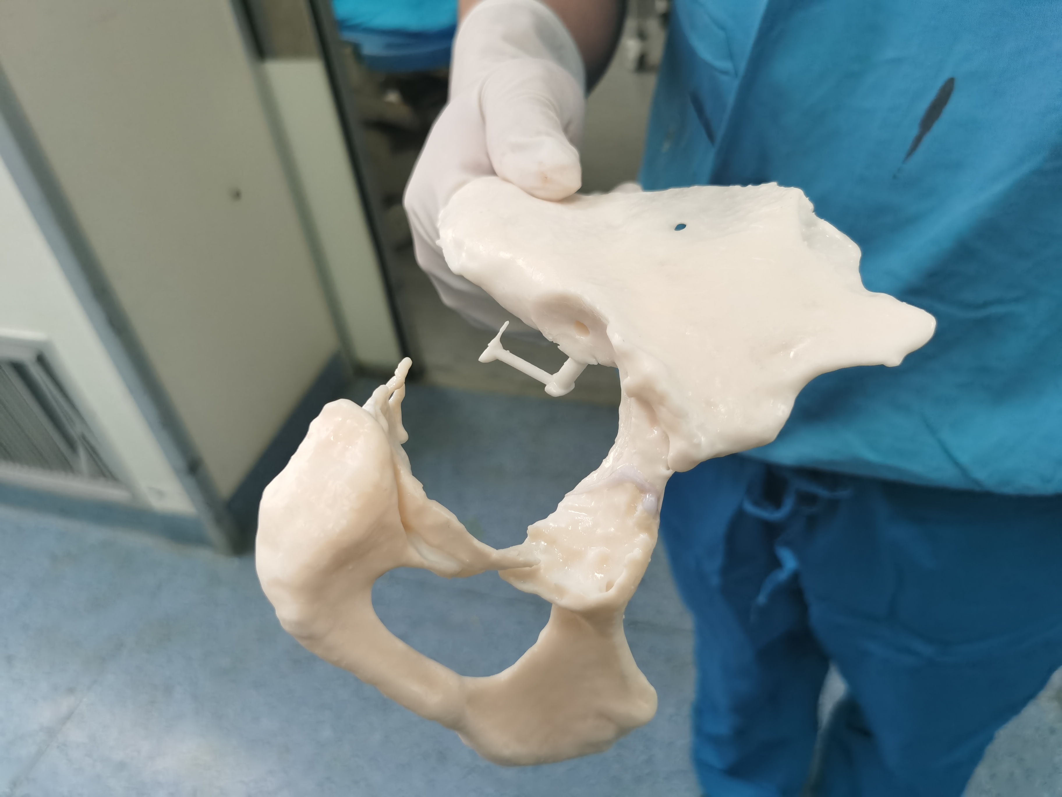 髋关节二次翻修手术红会医院,西安红会医院关节翻修