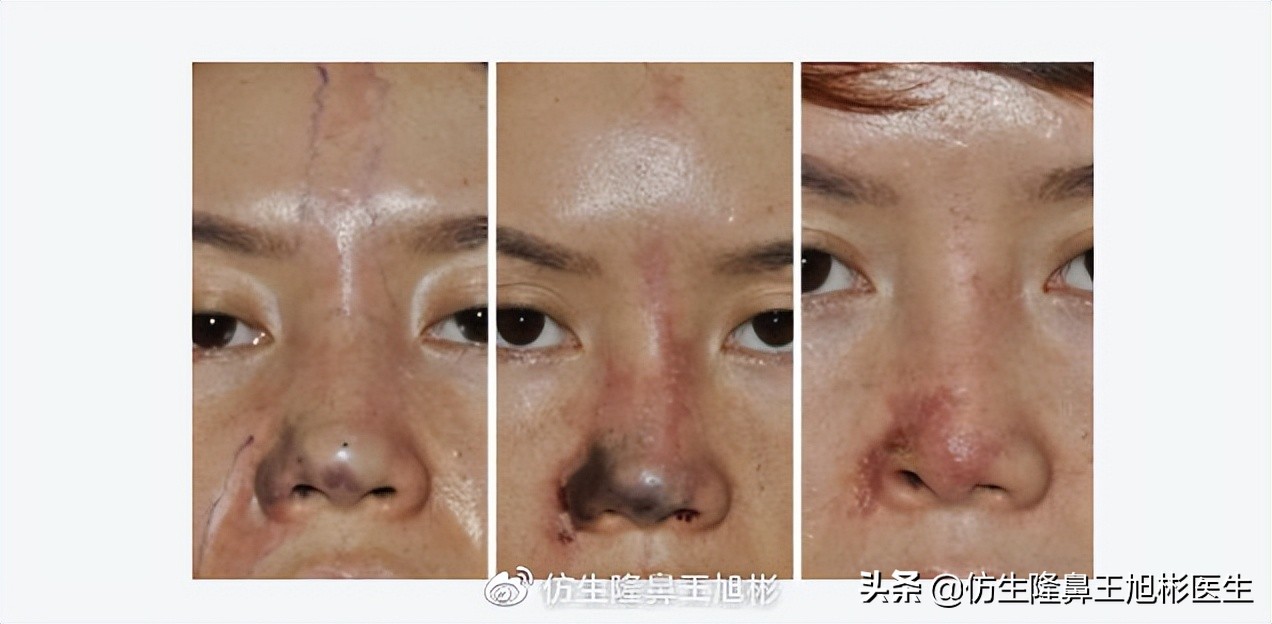 大宽朝天鼻整形过程,窄鼻子如何通过鼻整形来矫正