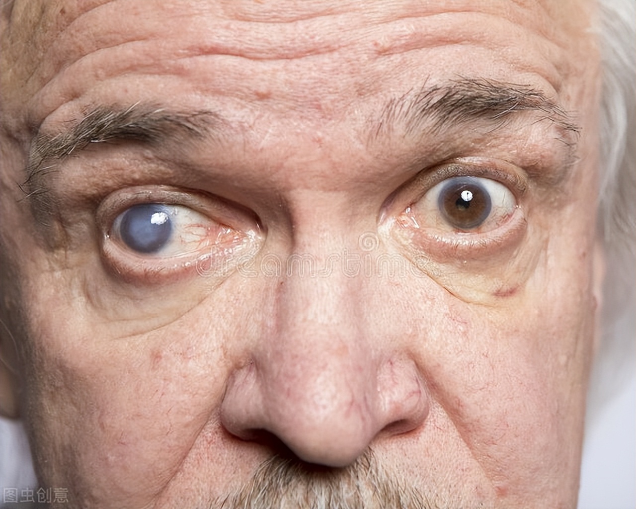 预防糖尿病眼底病变的药物,防治糖尿病视网膜病变