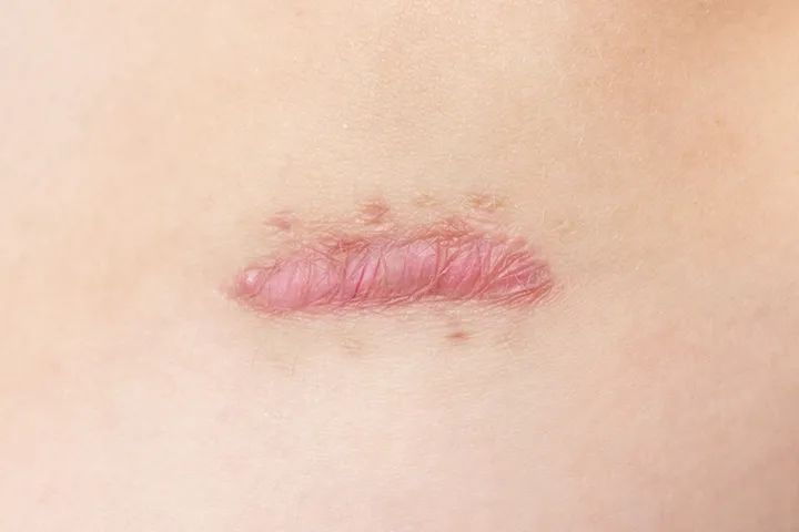 疤痕增生怎么预防治疗,疤痕的干预治疗