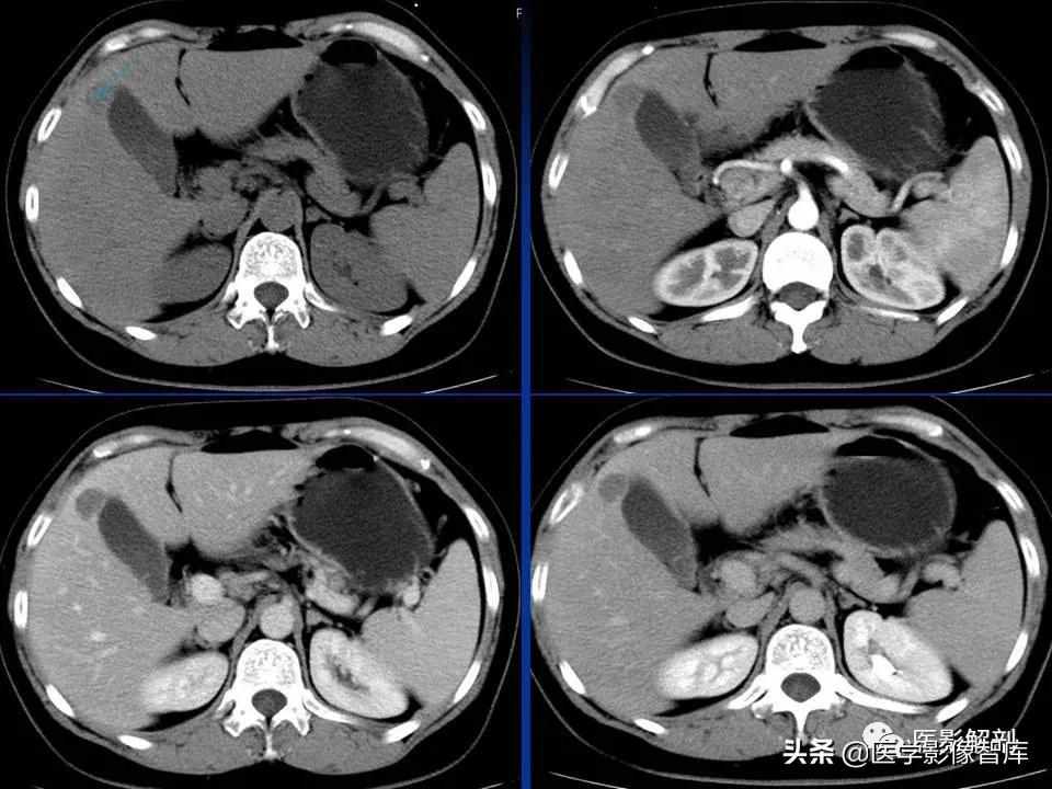 肝炎性假瘤鉴别诊断,肝炎性假瘤影像学表现