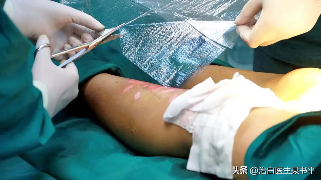 白癜风黑色素移植术整个过程,白癜风移植术为什么那么贵