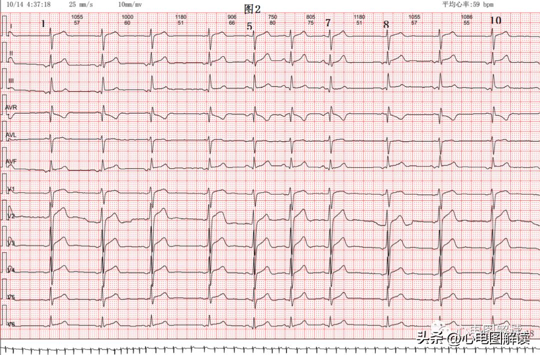 窦性心律部分见窦房游走性心律,窦性心律不齐游走性心律