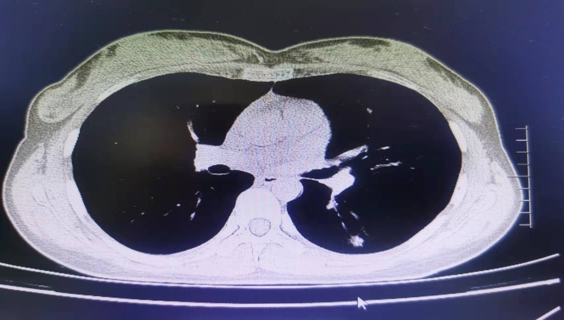 肺小结节诊疗科普,肺小结节怎么治疗最好