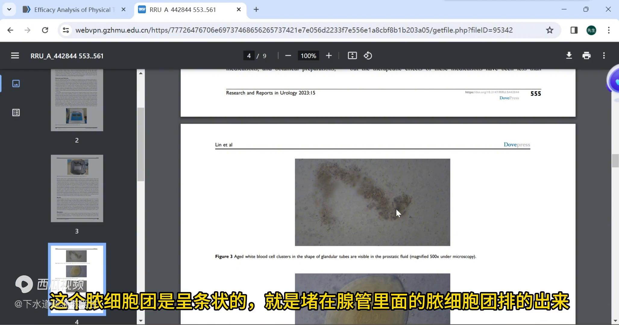 腺管疏通,前列腺炎腺管疏通治疗靠谱吗