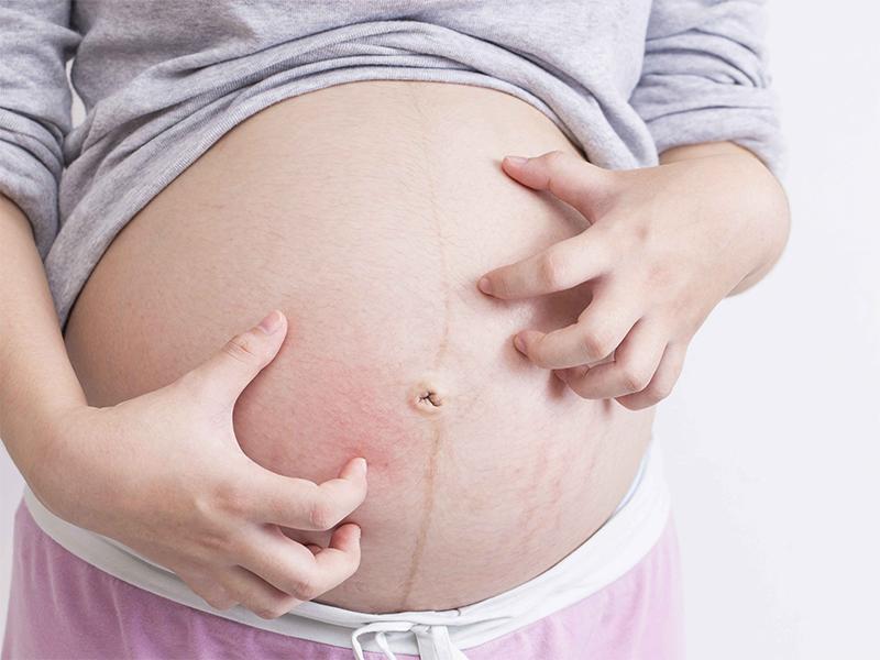 怀孕皮肤变黑产后多久可以恢复,怀孕身上皮肤变黑