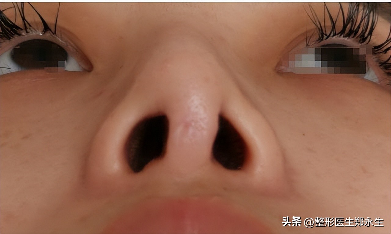 鼻子不满意在原医院修复要钱吗,鼻子坑修复最有效的方法