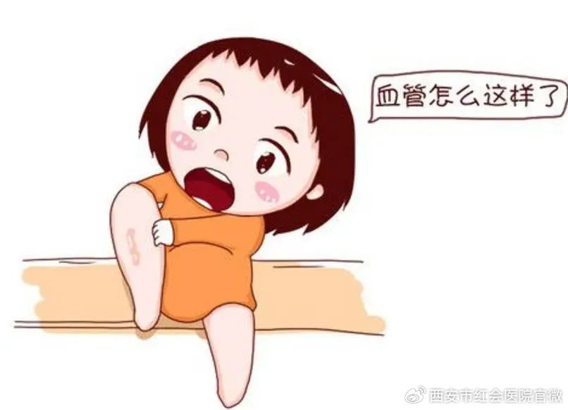 健康科普静脉血栓,火针治疗静脉曲张几天后出现淤血