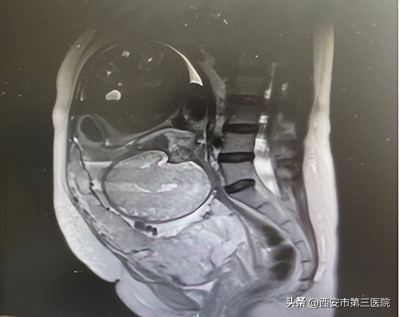 浴血奋战保卫祖国的精彩片段,凶险性前置胎盘一定会植入吗