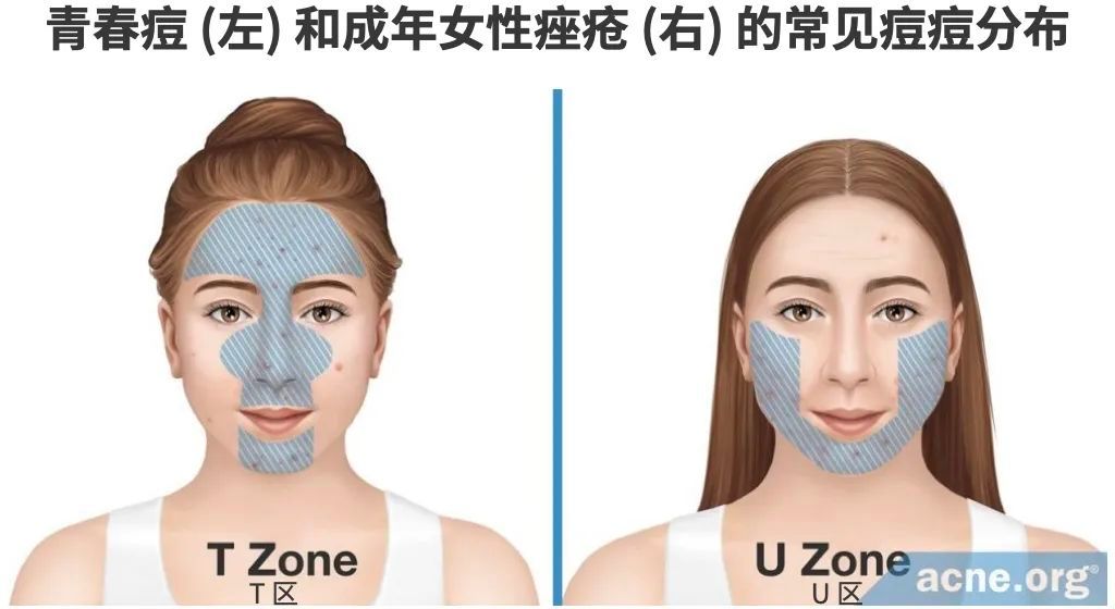 痘痘痘印痘坑改善全过程,学生祛痘痘和痘印痘坑简单的方法