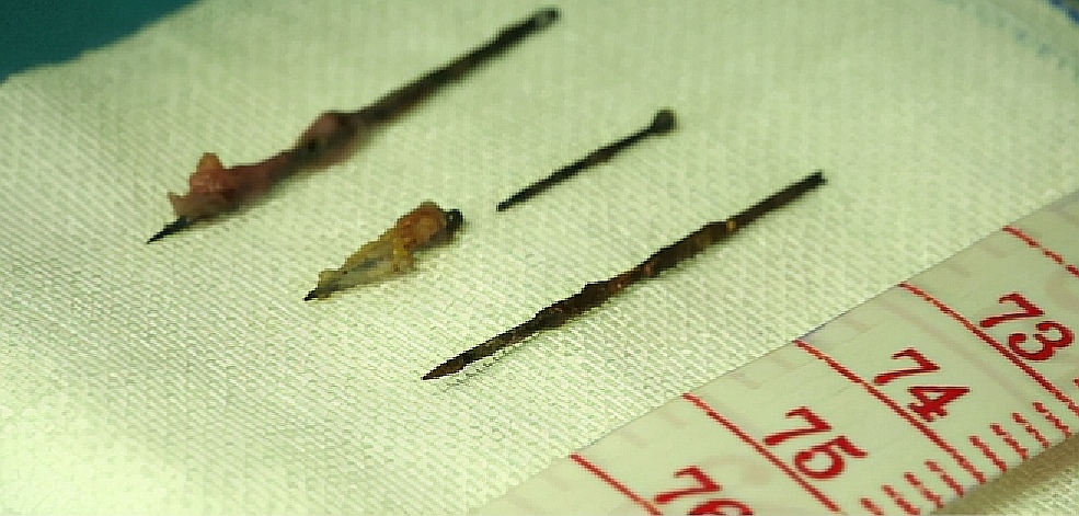 云南女子体内26根绣花针凶手是谁,云南女子缝衣针