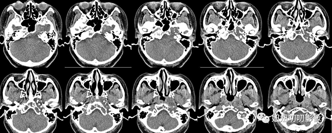 软骨肉瘤mri,骨肉瘤ctmr表现