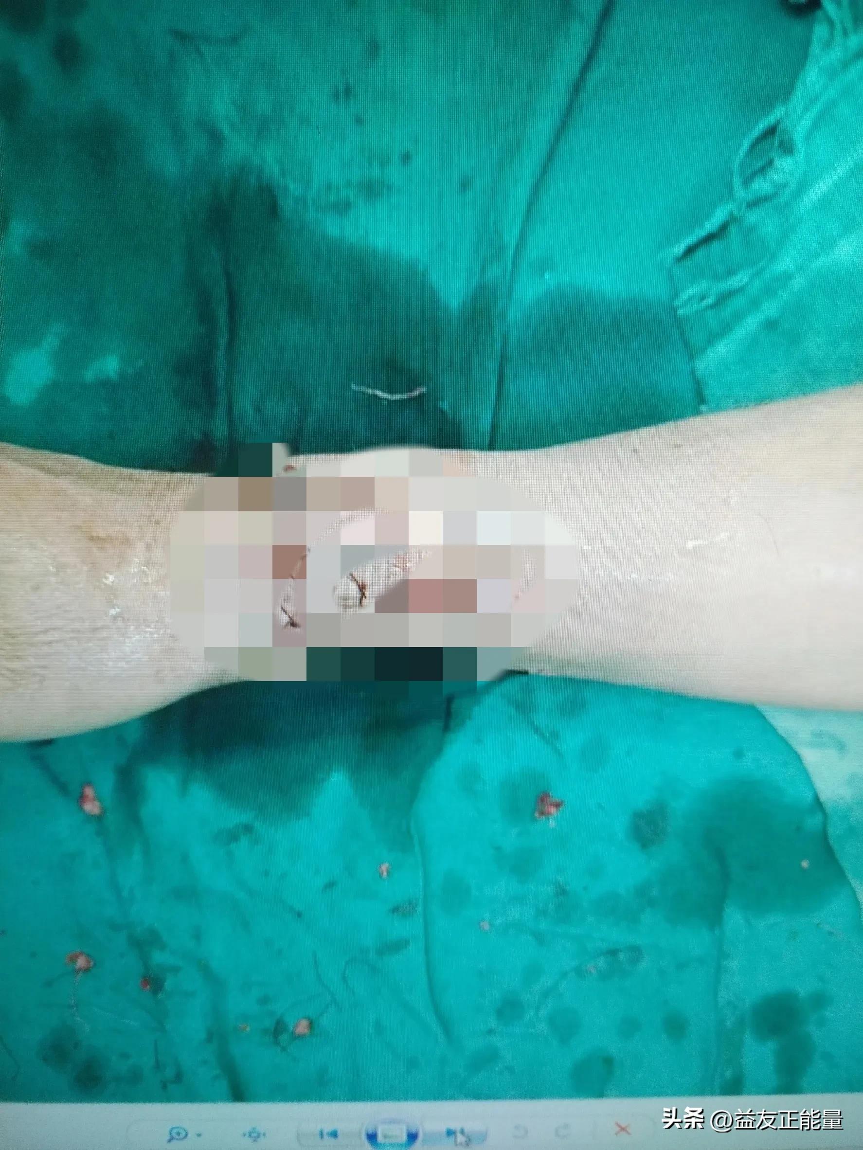 患者去民营医院包扎,被诱进手术室给做了手术,医生说断了二根筋