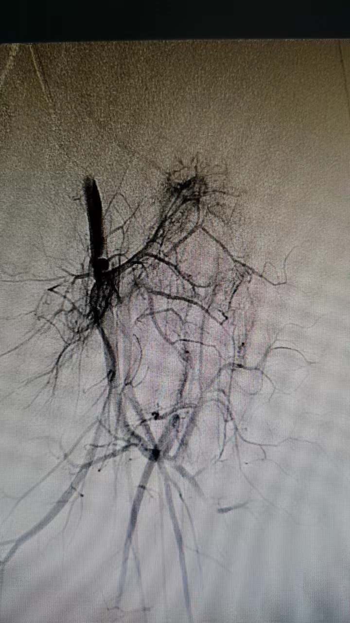 胎记竟然是血管罕见病，微创介入帮女童按下疾病“暂停键”