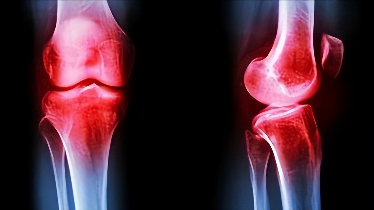 老年人膝关节疼痛吃哪种氨糖,80多岁老人关节痛用氨糖有用吗