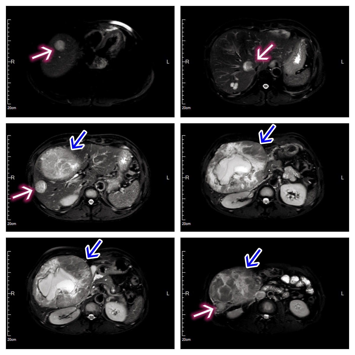 介入栓塞联合靶向,介入联合靶向能消除癌栓吗
