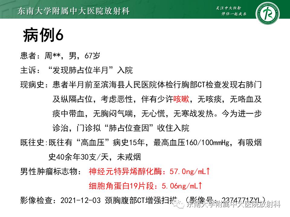 好文分享值得深思,纵隔精原细胞瘤