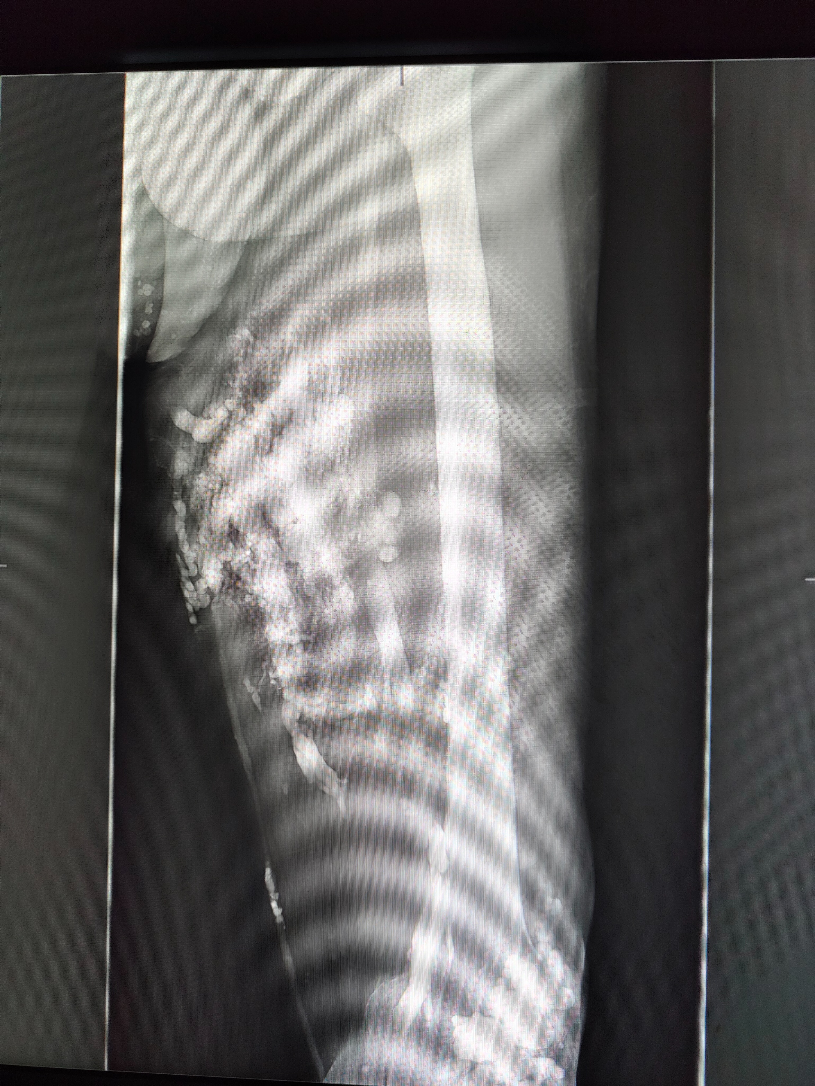 会不会良性血管瘤误诊成恶性,怎样预防血管瘤的发生