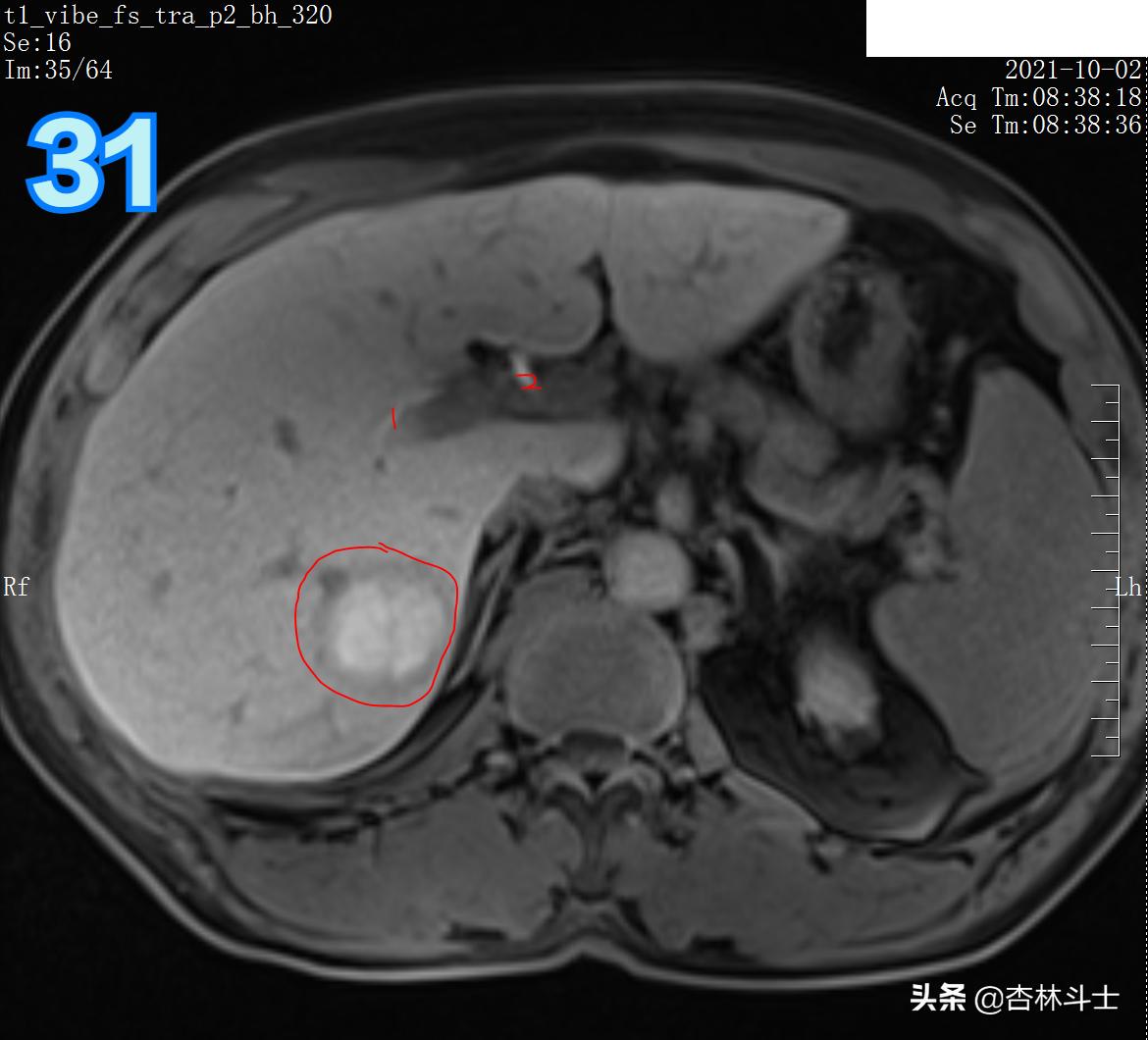 肝癌8公分肿瘤能活多久,肝癌细胞最大长多大