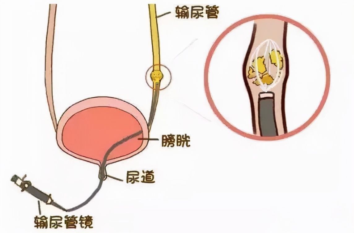 反复尿路感染最快解决方法,尿路感染耐药菌长期对人的危害
